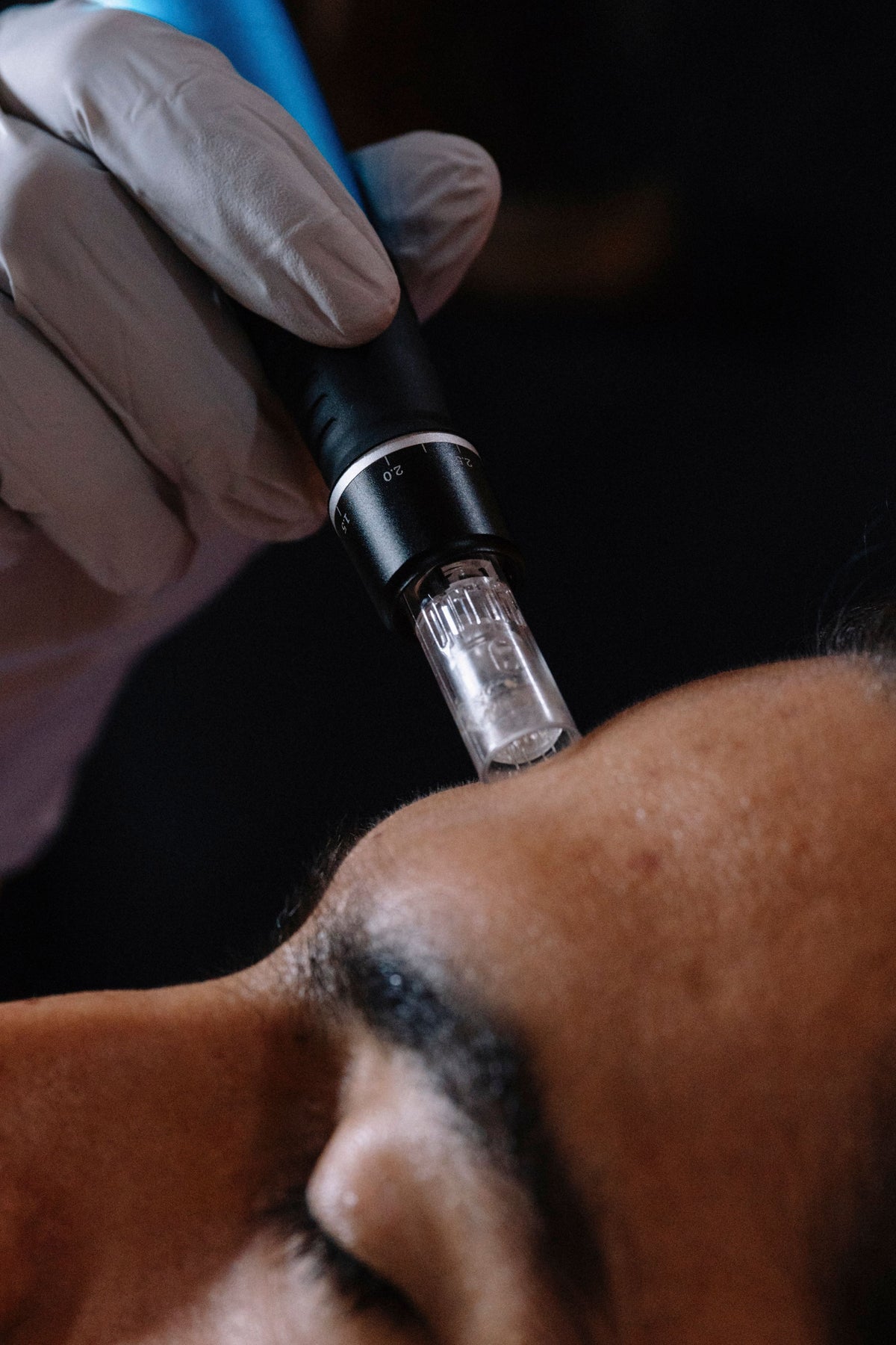 Microneedling
