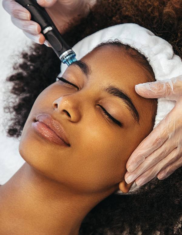 Microneedling